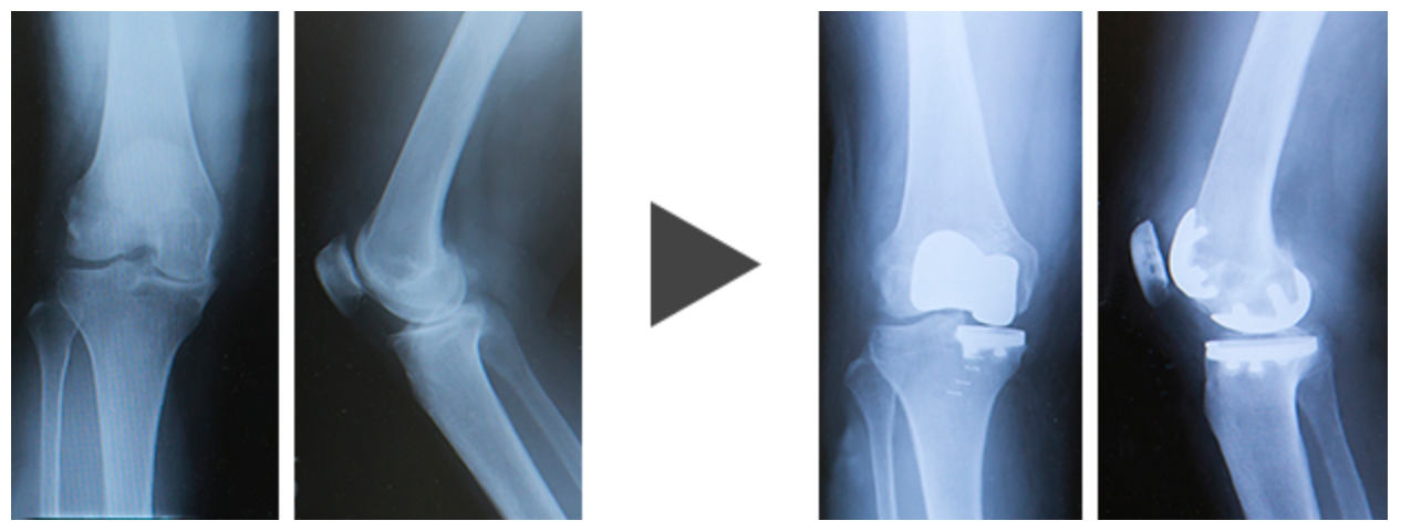 人工膝関節部分置換術