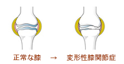 ひざの痛みの基本から説明