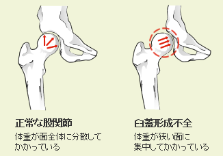 松崎 交作 先生 股関節の痛み 変形性股関節症と臼蓋形成不全 痛みを解消して 格好良く歩きたい 股関節の痛みの原因と治療法 人工関節ドットコム