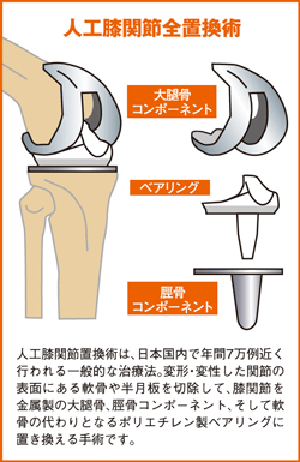 人口膝関節全置換手術