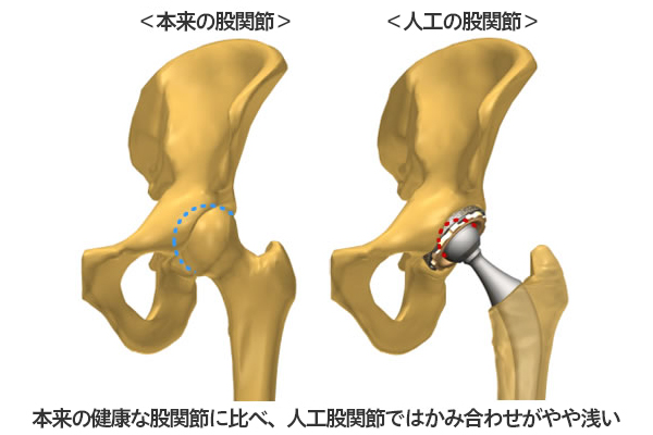 股関節と人工股関節の図