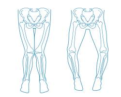 正常な脚（左）とＯ脚（右）