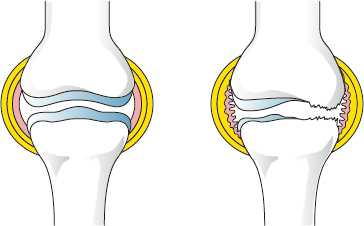 健康な膝（左）と痛んだ膝（右）