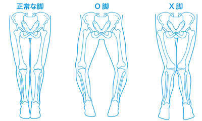 膝関節（正常、Ｏ脚とＸ脚）
