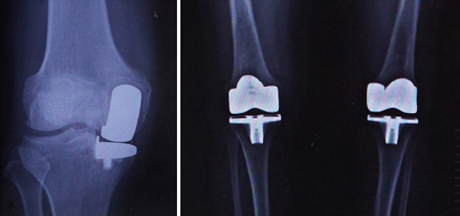 部分置換術後と両側人工膝関節全置換術後のレントゲン、いろいろな方法があります。