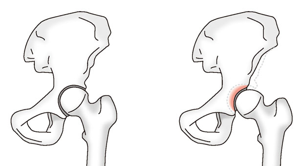 通常の股関節（左）と寛骨臼形成不全（右）