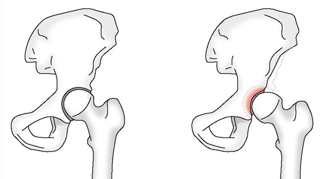 正常な股関節と寛骨臼形成不全