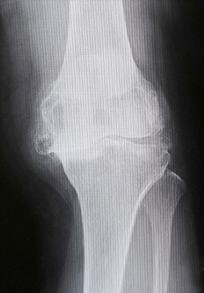 人工膝関節症のレントゲン