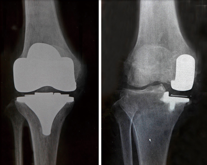 人工膝関節全置換術（左）と部分置換術（右）のレントゲン
