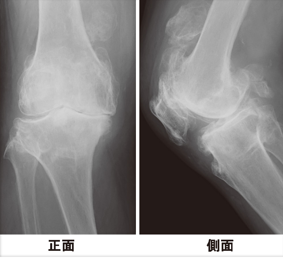 変形性膝関節症のX線画像