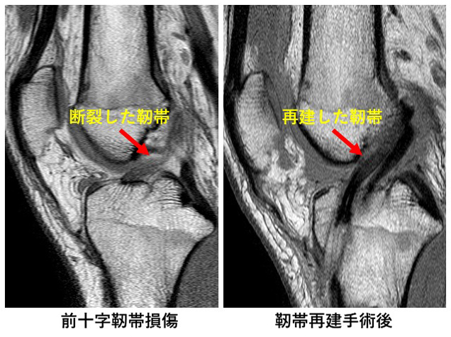 前十字靭帯損傷のMRI画像