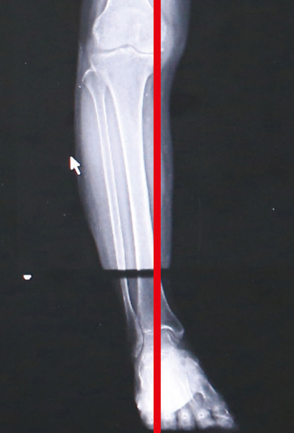 O脚は、体重負荷線が内側にあります。