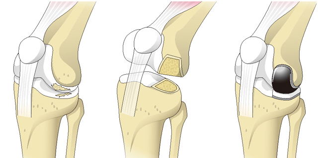 人工膝関節単顆置換術