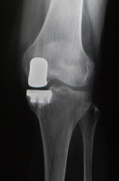 人工膝関節単顆置換術後のレントゲン