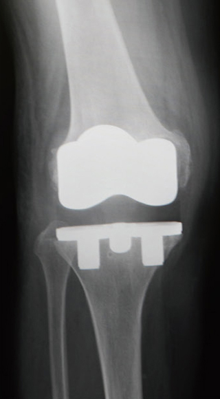 人工膝関節全置換術後のレントゲン（正面）