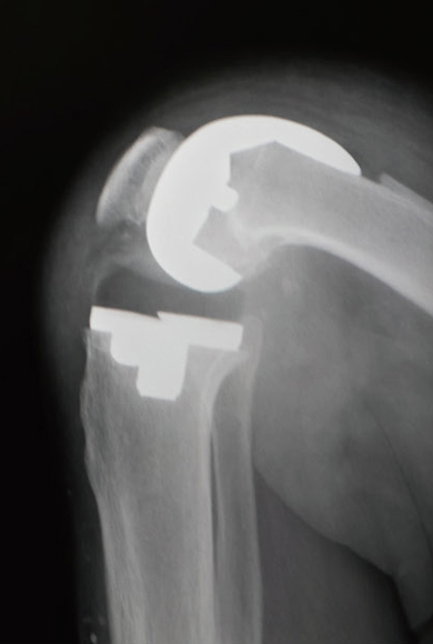 人工膝関節全置換術後のレントゲン（側面）