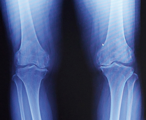 変形性膝関節症のレントゲン