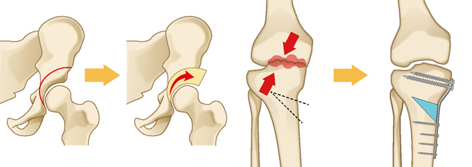 骨切り術（股関節と膝関節）