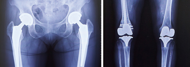人工関節置換術後のレントゲン（両脚股関節と両脚膝関節）