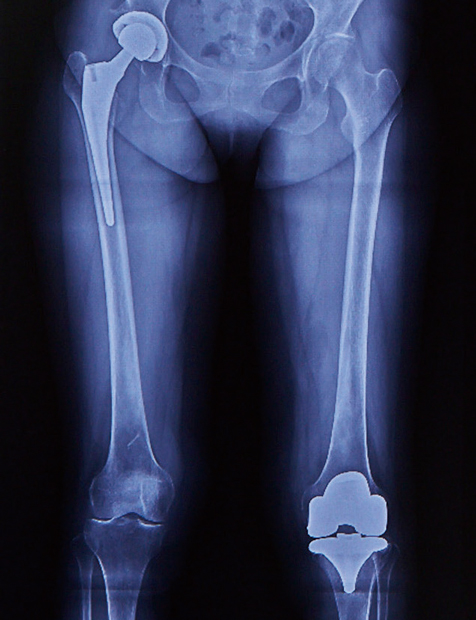 股関節と膝関節に人工関節置換術後のレントゲン