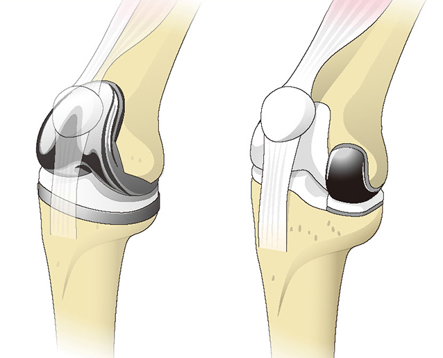 人工膝関節全置換術（左）と人工膝関節単顆型置換術（右）