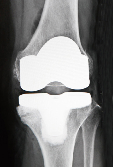 人工膝関節置換術後のレントゲン