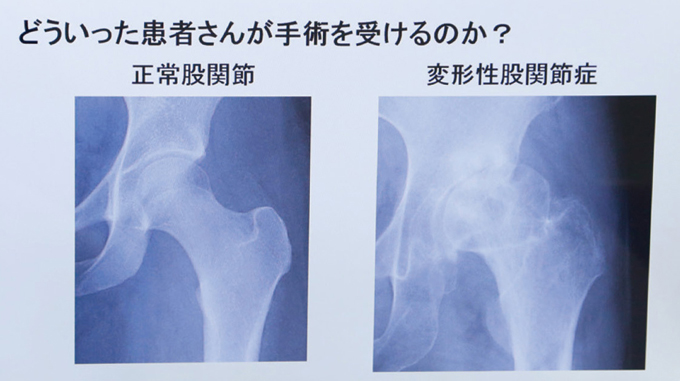 坂越 大悟 先生 | 脱臼しづらい人工股関節置換術 | 満足度の高い治療を 