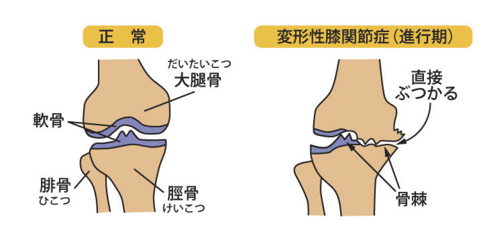 正常時と変形性膝関節症のイラスト