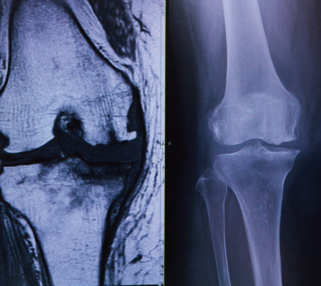 膝関節の脆弱性骨折のMRIとレントゲン