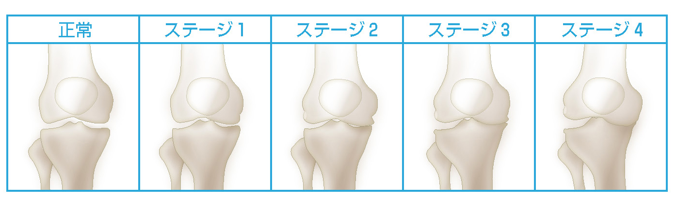 変形性膝関節症の分類