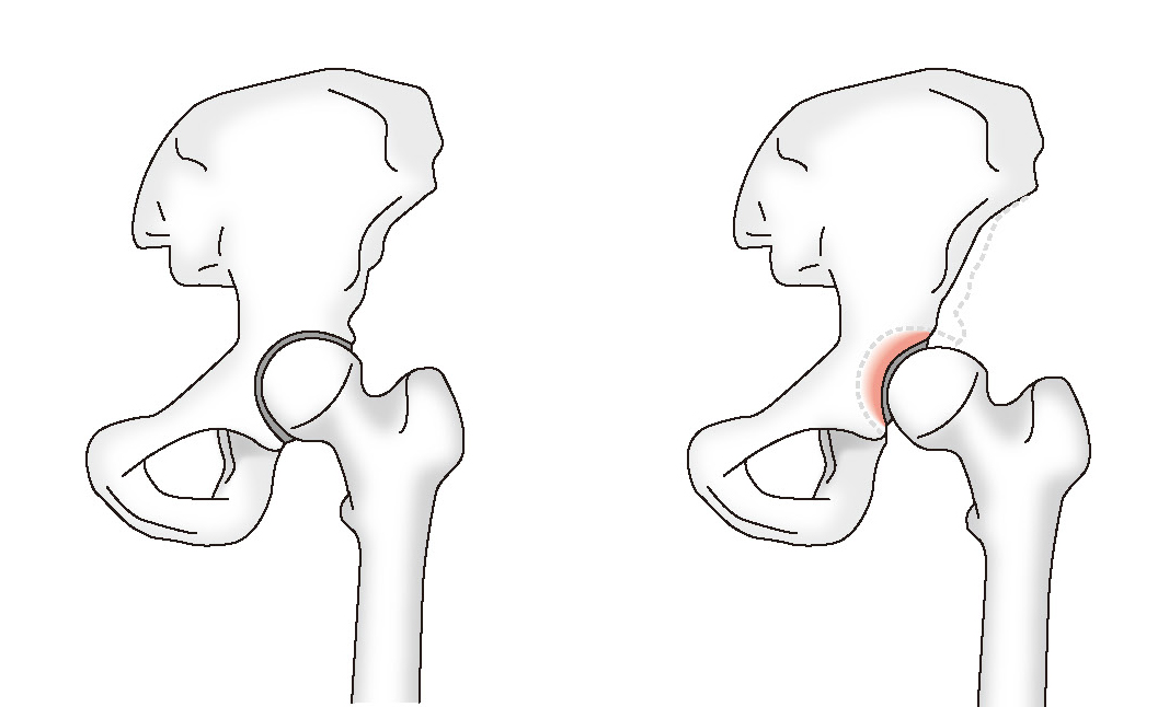 正常な股関節（左）、寛骨臼形成不全（右）