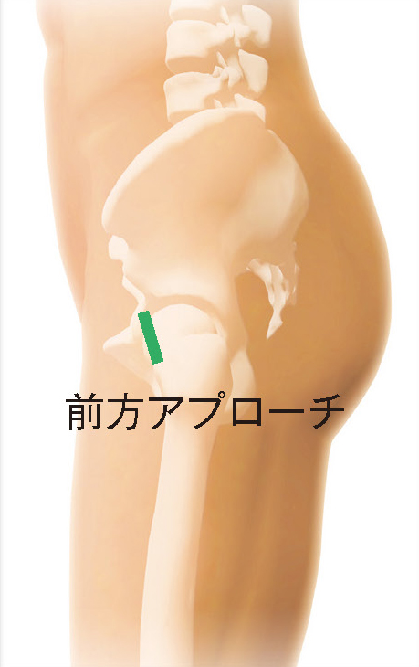 角田 俊治 先生 | 前方からのアプローチで脱臼リスクを低減 | 股関節の 