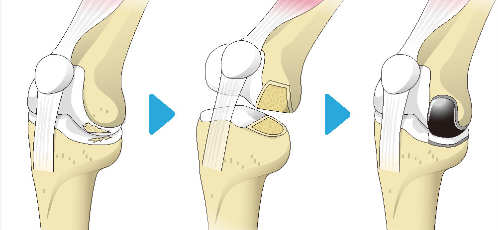 人工膝関節部分置換術の流れ