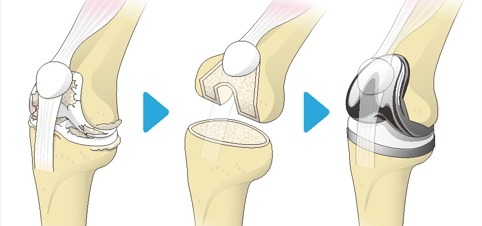 最も 膝 人工膝関節 手作り 臓器 キーホルダー ハンドメイド