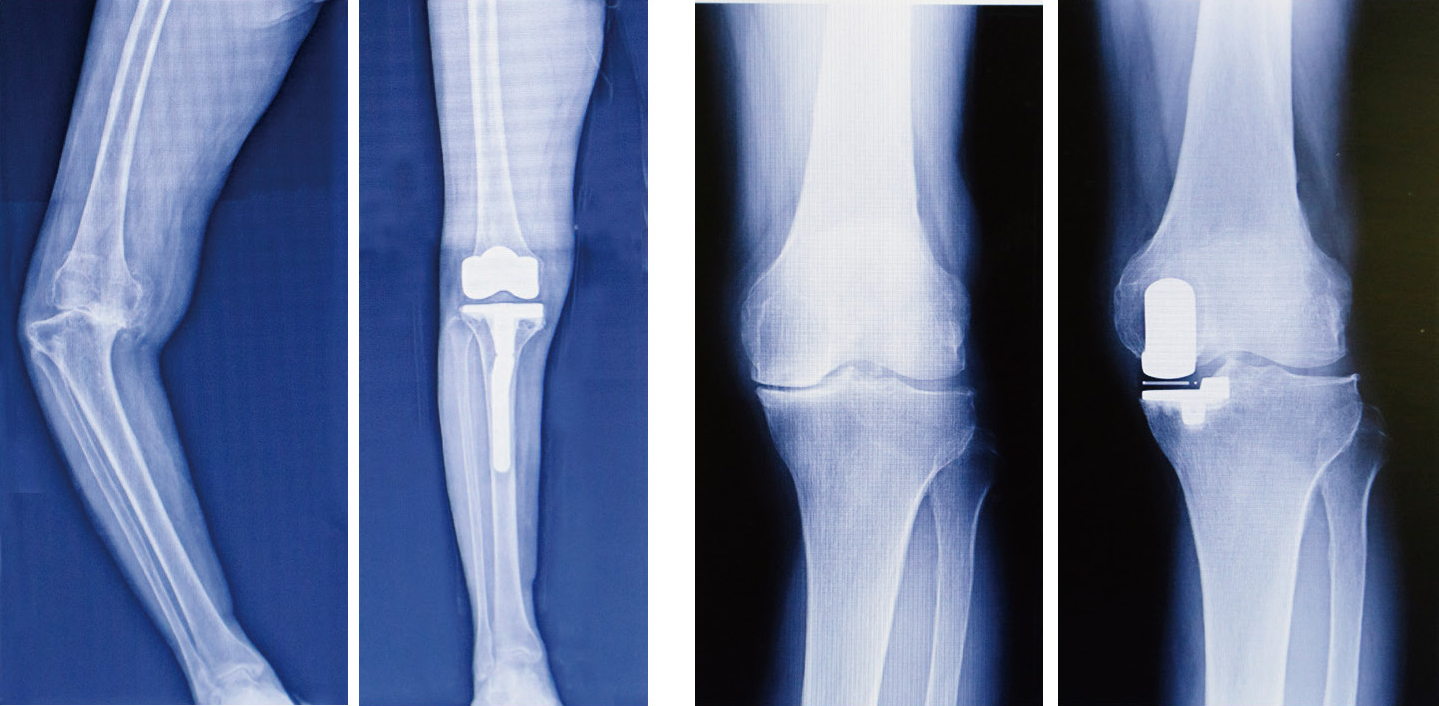 術前と人工膝関節全置換術後のレントゲン／術前と人工膝関節部分置換術後のレントゲン