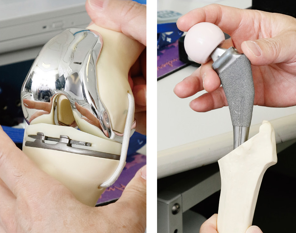 人工膝関節と人工股関節の一例
