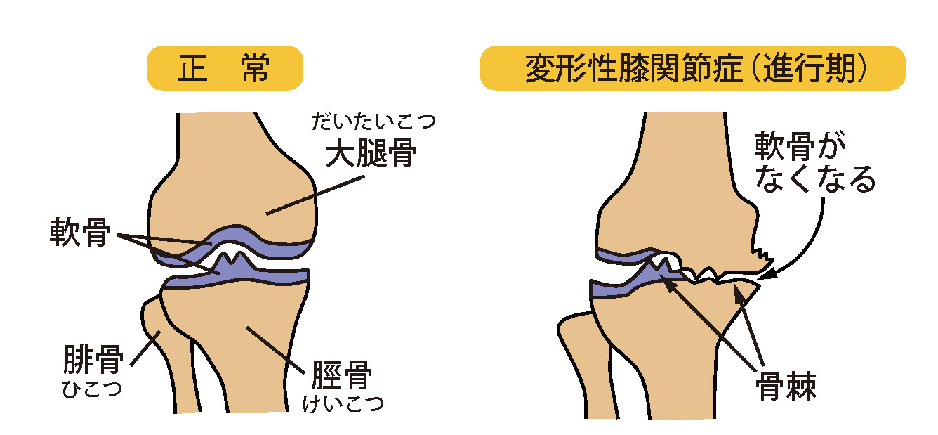 正常な状態と変形性膝関節症のイラスト