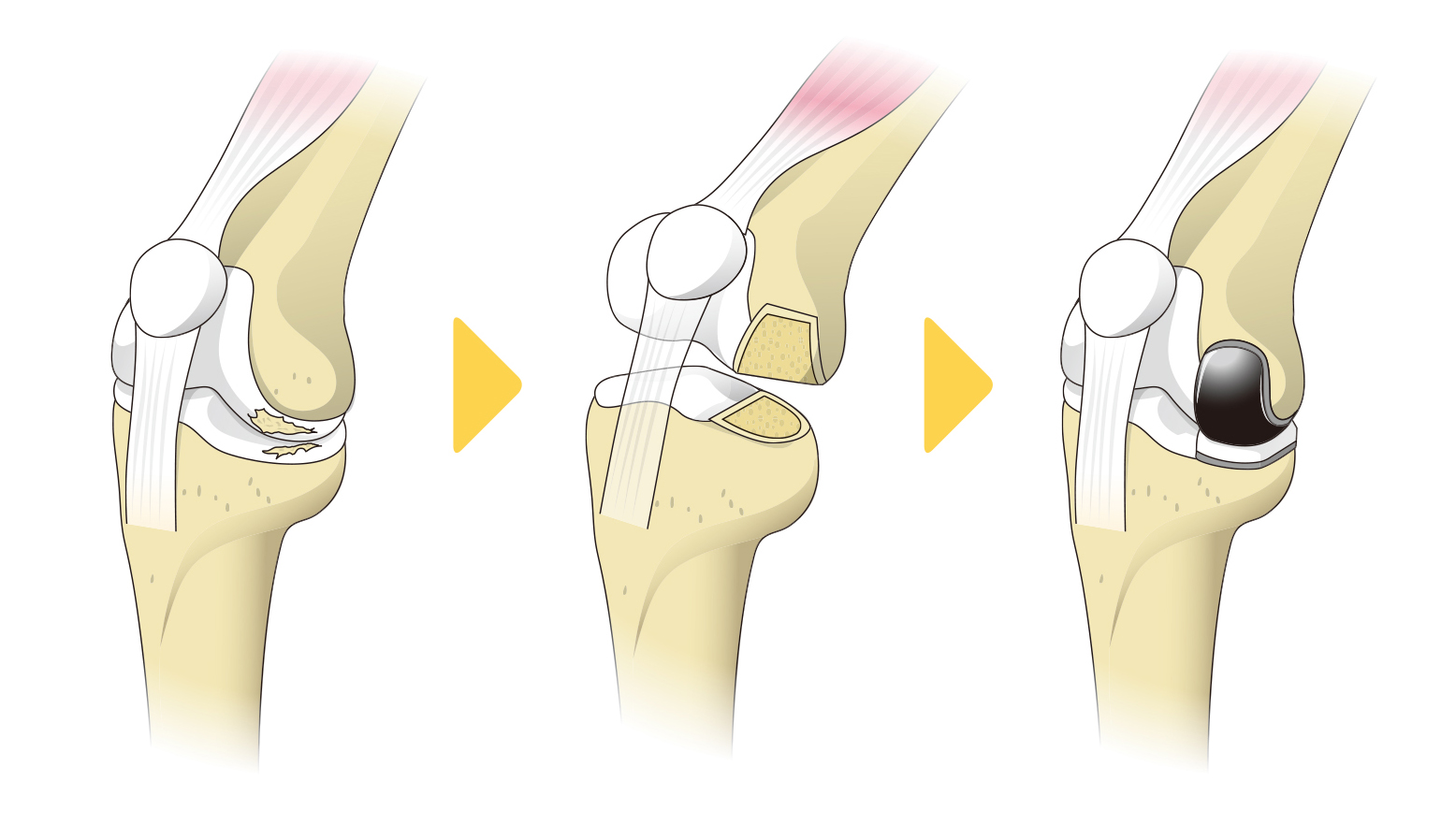 人工膝関節単顆置換術の流れ