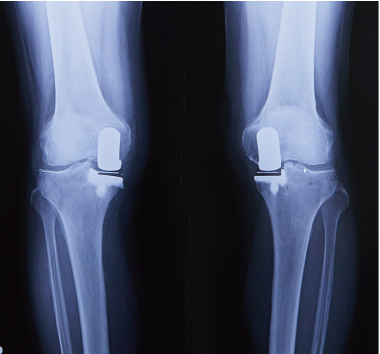 人工膝関節部分置換術後の
レントゲン（両脚）