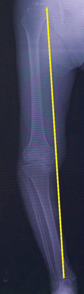 O脚のレントゲン（体重がかかる軸が膝の内側に偏っています）