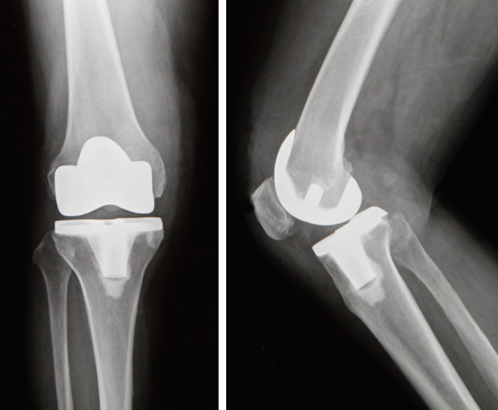 人工膝関節全置換術後のレントゲン（正面と側面）