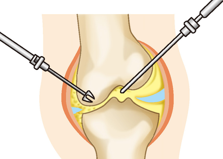 大槻 康雄 先生 除痛効果に優れ 患者満足度が高い人工膝関節置換術 生活の質を低下させる 膝の痛み 早めに専門医に相談し 歩ける膝 を取り戻そう 人工関節ドットコム
