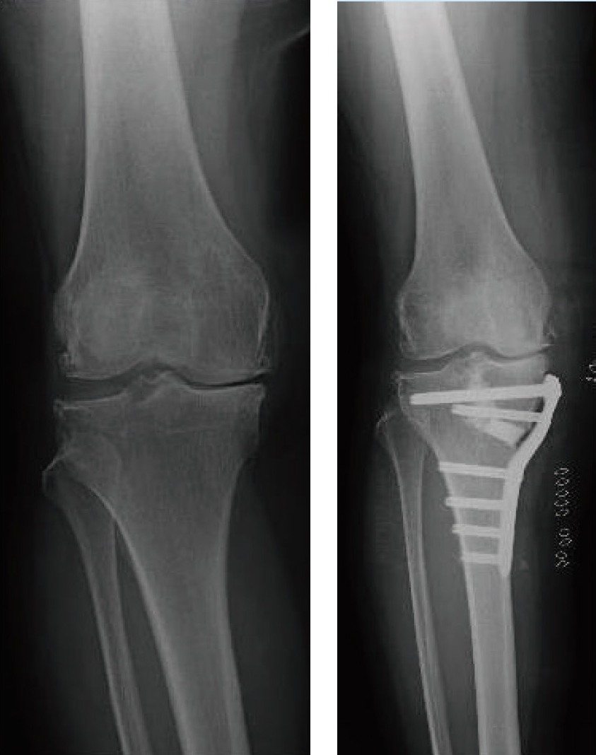 脛骨顆外反骨切り術（TCVO）のレントゲン