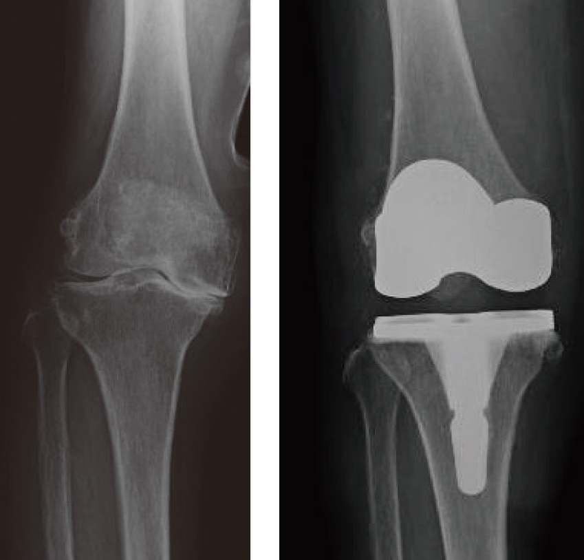 後十字靭帯が拘縮している場合の人工膝関節置換術のレントゲン