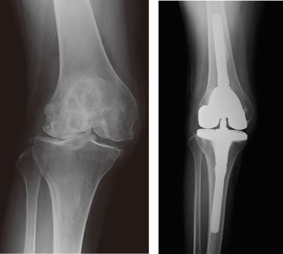 拘束性の強い人工膝関節置換術のレントゲン