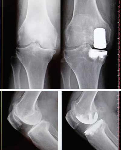 術前と人工膝関節部分置換術後のレントゲン（上：正面、下：側面）