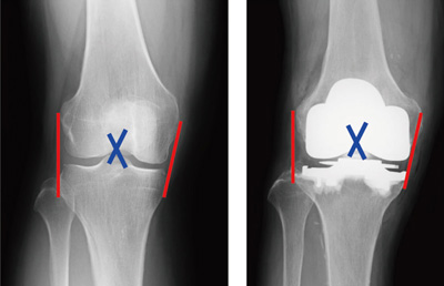 術前と人工膝関節全置換術後のレントゲン