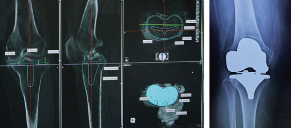 3D（立体画像）による術前計画と人工膝関節全置換術後のレントゲン