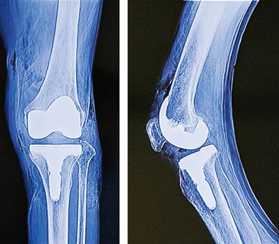 人工膝関節全置換術後のレントゲン
（正面と側面）