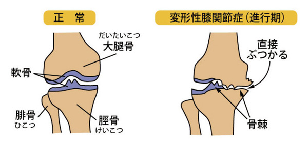正常／変形性膝関節症のイラスト